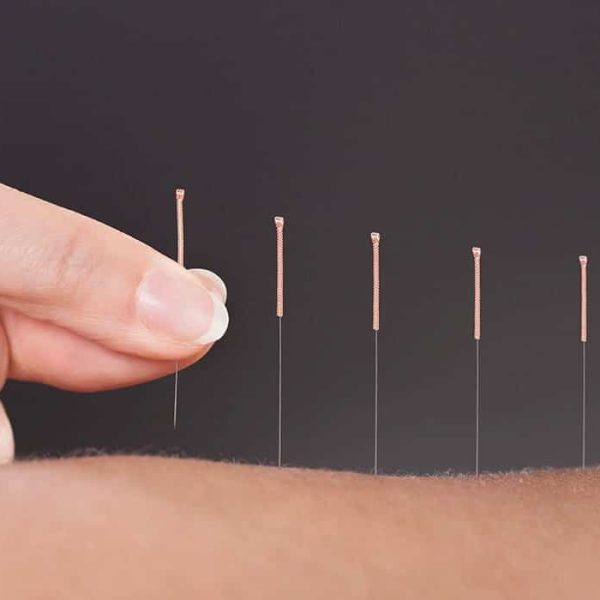Acupuncture-1400x700