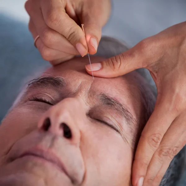 Well-Medicare-Acupuncture-GettyImages-636209348
